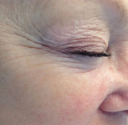 Vorher: Augenpartie vor OxyGeneo